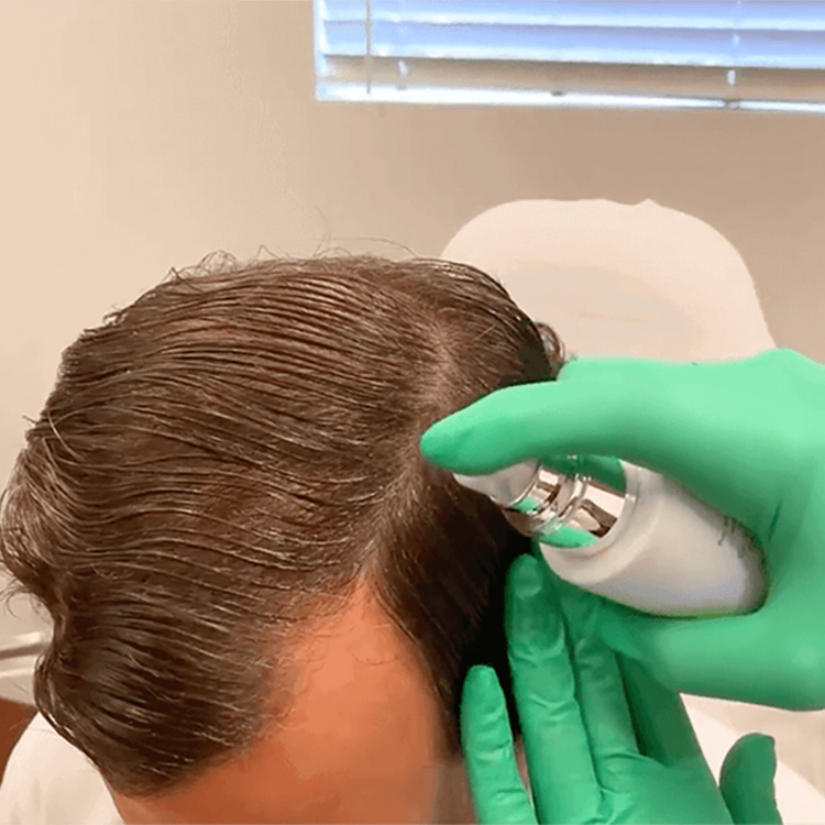 Diamond InstaMane treatment for thinning hair by Dr. Jason B. Diamond