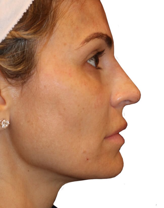 The Diamond Facial Sculpting Patient 16 - Jason B. Diamond